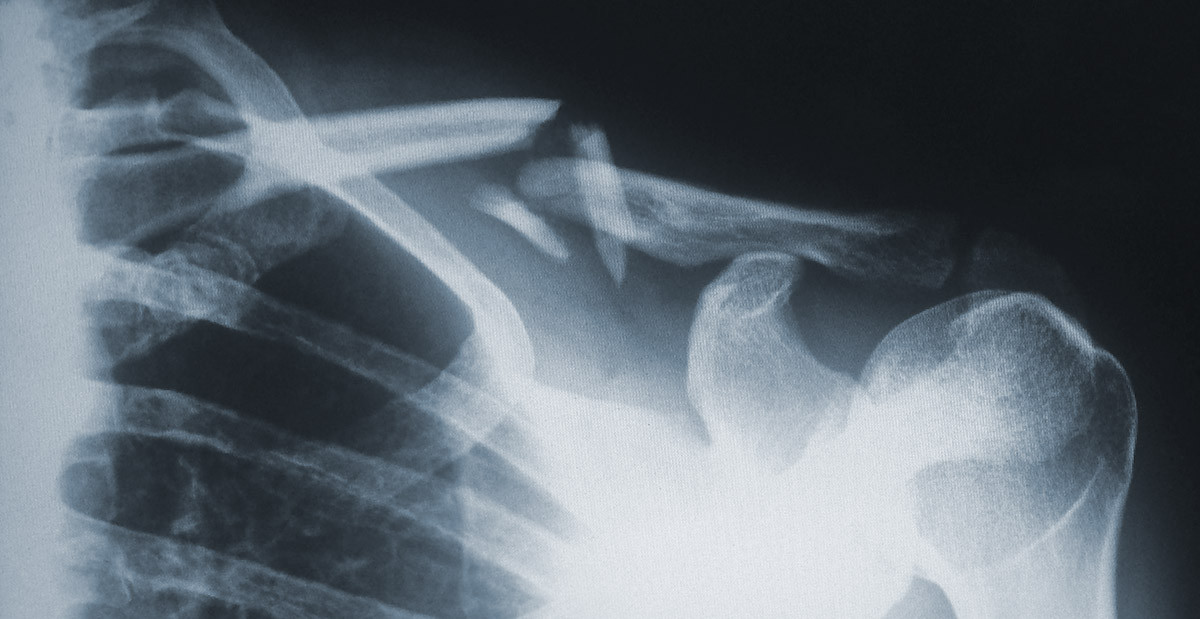 Fatigue Fractures