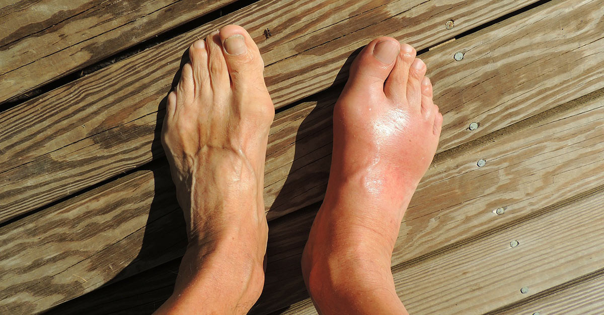 Gout