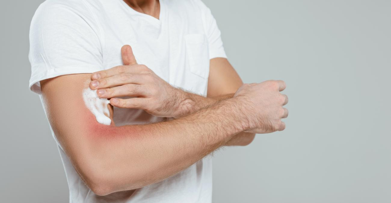 Dermatitis