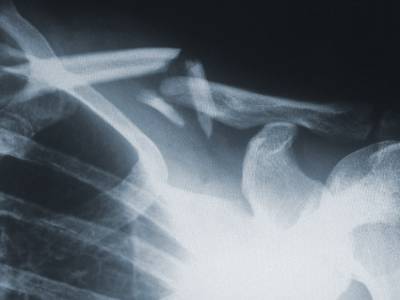 Fatigue Fractures