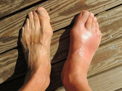 Gout